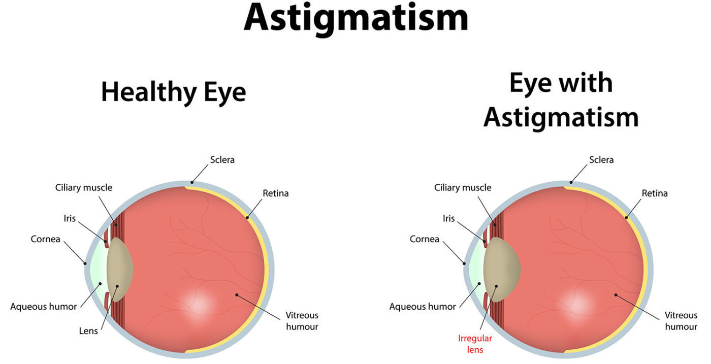 Normal vs Astigmastim Eye f4159788da6a13a05c7755e7e3b29890